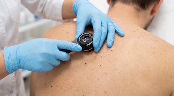 Manos con guantes celestes usan un dermatoscopio para examinar lunares en la espalda de un paciente.