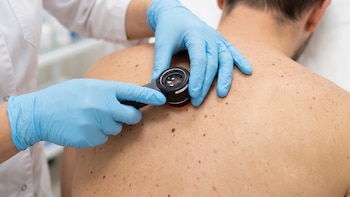 Avance contra el cáncer de piel: una vacuna ARNm logró prevenir la reaparición o diseminación del melanoma