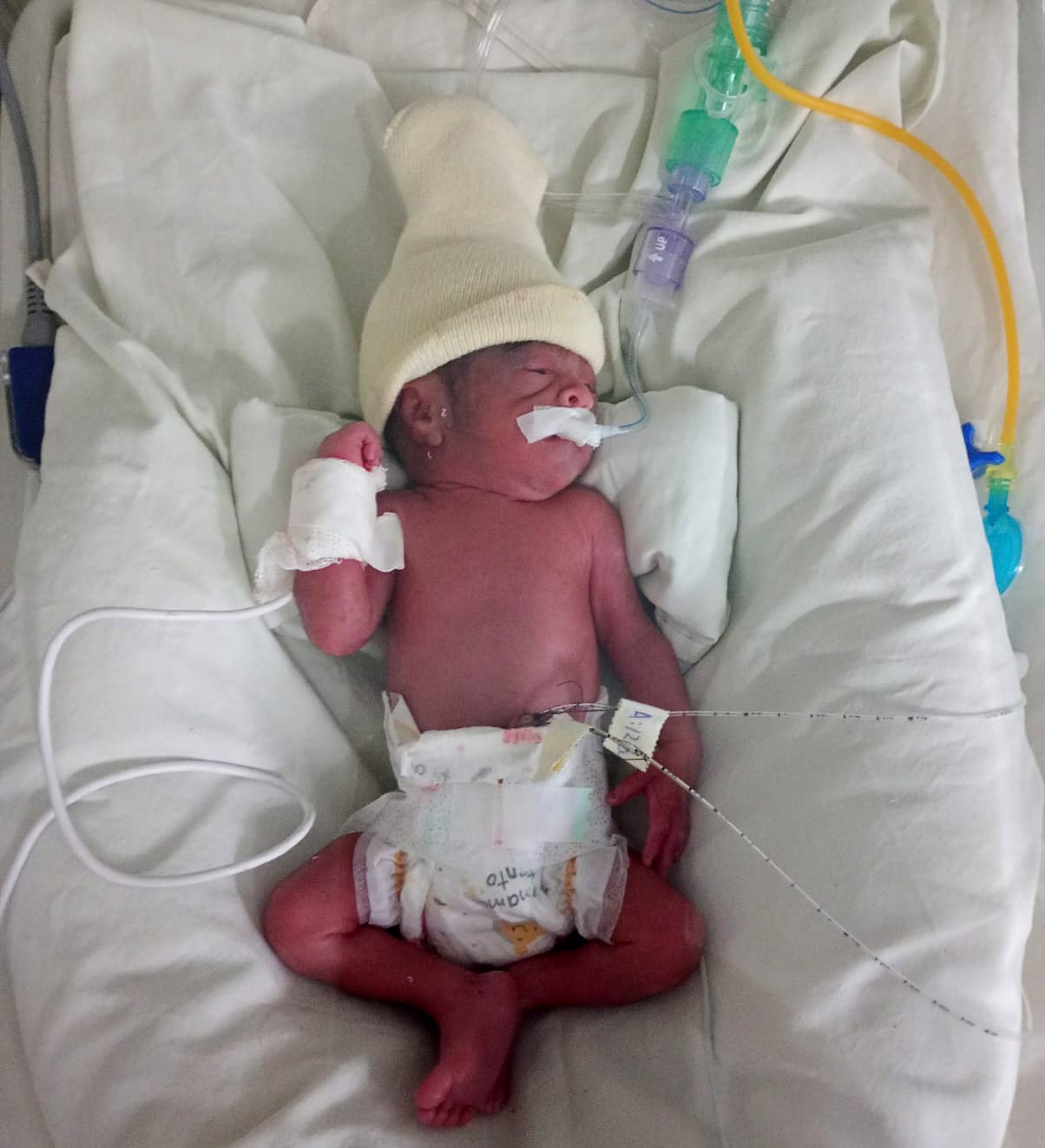 La primera imagen de Amely. La beba nació el 15 de febrero con solo 27 semanas de gestación y un peso de 940 gramos