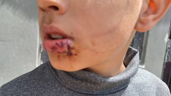 Nuevo ataque de un perro en Córdoba: un nene fue mordido por un pastor alemán mientras jugaba a la pelota