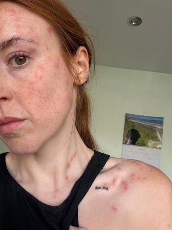 Fue a un hotel por una noche y terminó cubierta de picaduras de chinches