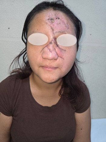 Persona con cabello oscuro y camiseta marrón. Rostro con cicatrices, marcas quirúrgicas en frente y nariz. Ojos cubiertos. Fondo claro