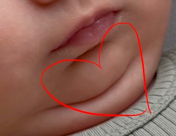Primer plano del rostro de un bebé, mostrando su boca y mejilla. Un contorno de corazón rojo está dibujado sobre la mejilla. Se ve ropa gris con rayas