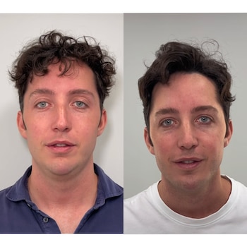 Francisco Nicolás, antes (I) y después (D) de someterse a rellenos estéticos