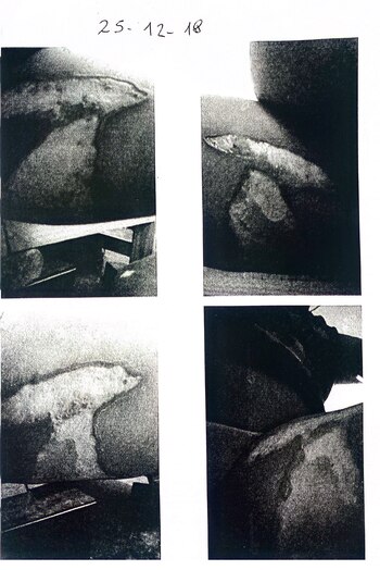 ufrió quemaduras de tipo A