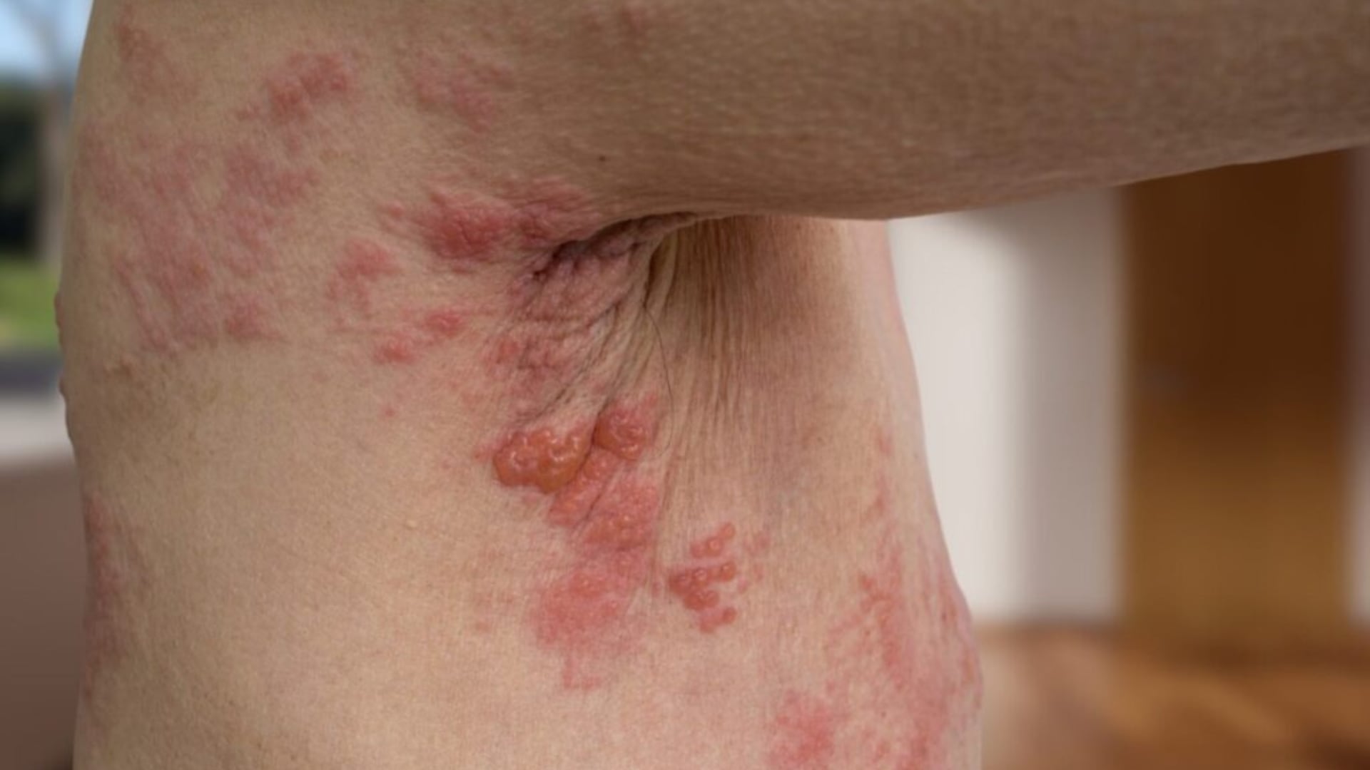 El virus varicela-zóster permanece inactivo durante años y puede reactivarse en situaciones de estrés (Clínica Javier Prado)