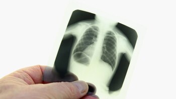 VSR incrementa en México (Foto: