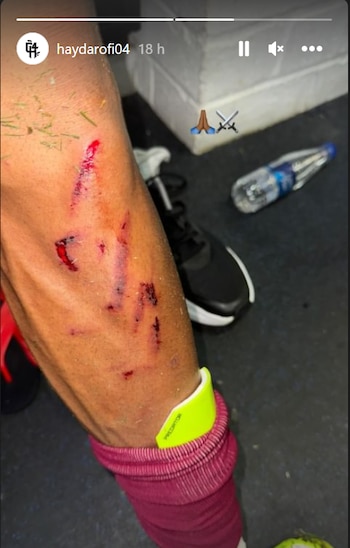 Cesar Haydar mostró su pierna izquierda