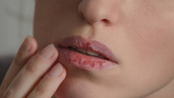 ¿Labios secos y agrietados? Esta