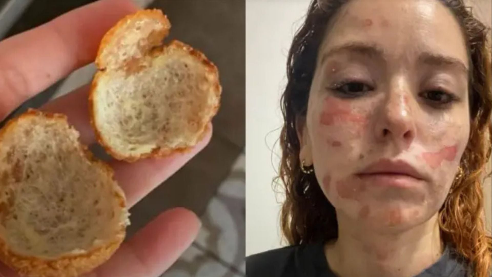 Mujer relata las graves quemaduras que sufrió tras la explosión de un buñuelo: “Cómprenlos, no los hagan”