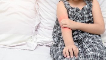 No hay buenas formas de evitar el eccema infantil, pero sí muchas opciones de tratamiento