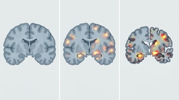 Tres secciones coronales de cerebros ilustran un cerebro sano, uno con depósitos de proteína tau en el hipocampo y la corteza, y otro con atrofia cerebral marcada.