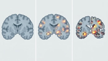 Cómo evoluciona el alzhéimer: identifican tres formas de progresión de la enfermedad