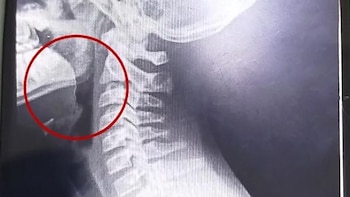 Radiografía lateral en escala de grises de la parte superior de la columna cervical y el cráneo, con un círculo rojo resaltando el área de la garganta