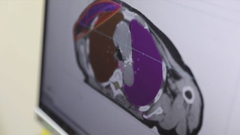 Los cánceres de pulmón en