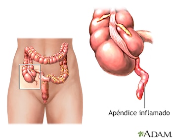 Imagen de referencia al apendicitis