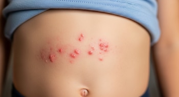 Primer plano del abdomen de un niño que muestra una erupción cutánea rojiza y elevada con pequeñas protuberancias y el ombligo visible.