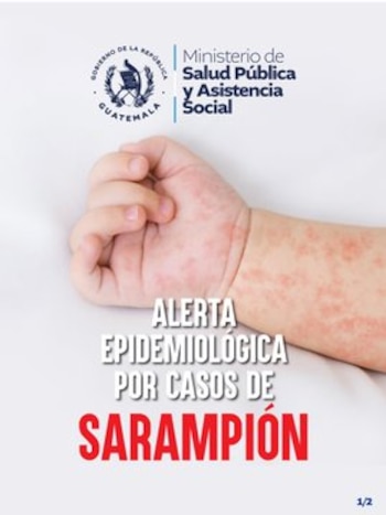 Las autoridades sanitarias advirtieron que un solo caso de sarampión puede mantener la circulación del virus y que la falta de vacunación completa eleva el riesgo de contagio.