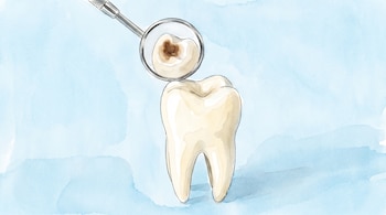 Ilustración en acuarela de un diente de color crema con una caries oscura, reflejado en un espejo dental metálico sobre un fondo azul claro.