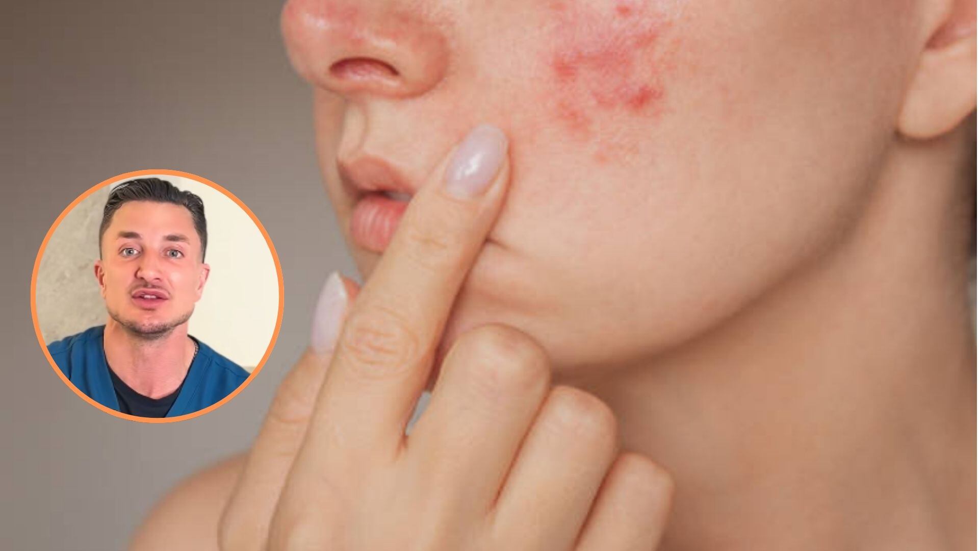 El acné y su localización: claves para entender su origen según un dermatólogo