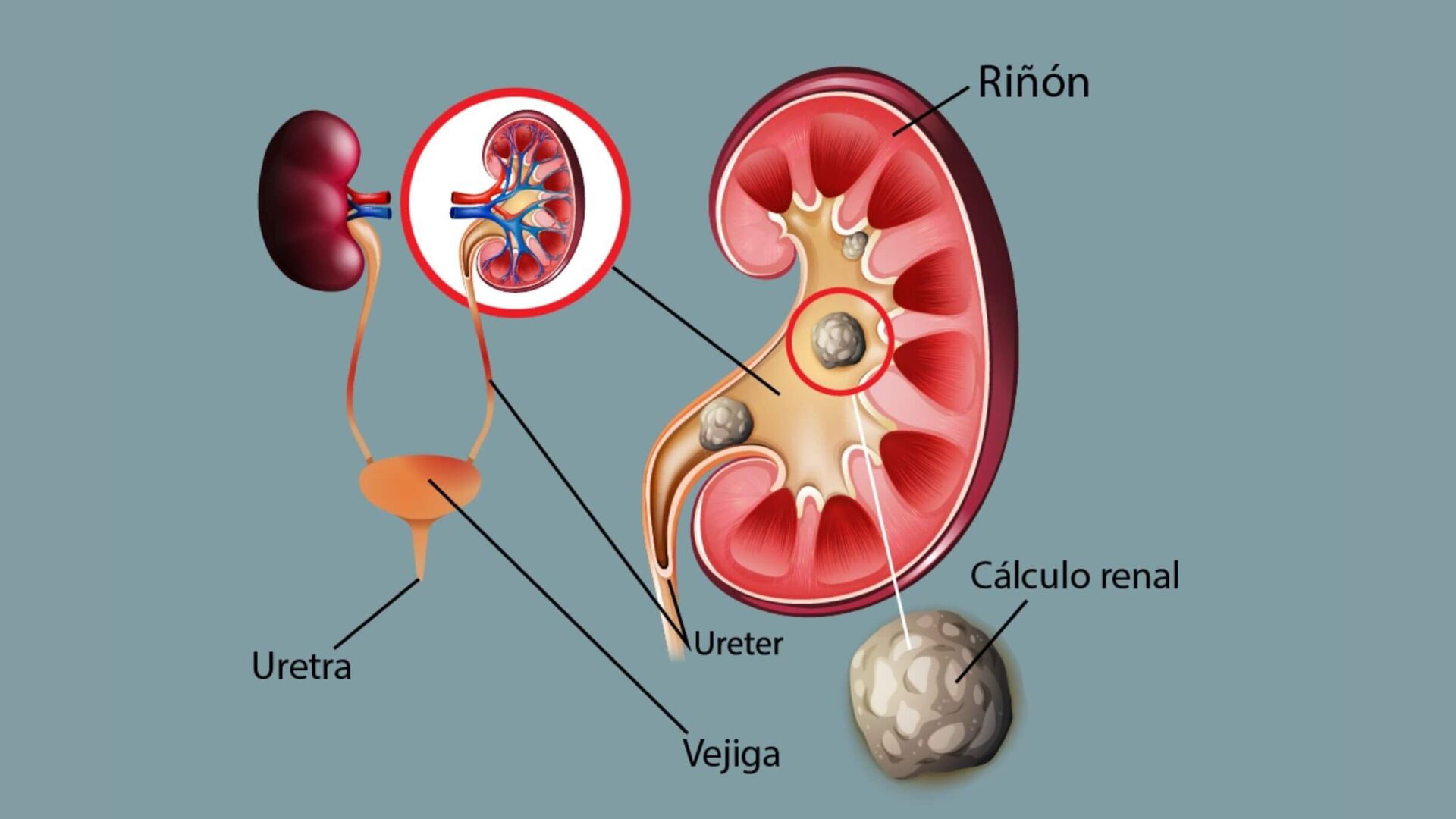 Entre las afecciones más frecuentes que atiende la urología están los cálculos renales (Gabinete de Urología y Andrología)