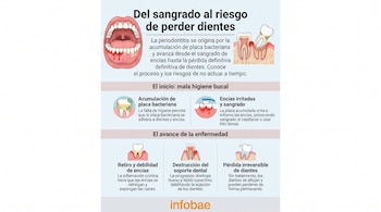 Infografía con ilustraciones de boca con encías sangrantes, dientes, placa bacteriana, cepillo, daño dental, y texto explicativo sobre periodontitis. Fuente: Infobae.