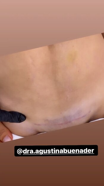 Barby Franco mostró la cicatriz