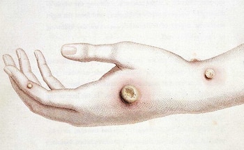 Es una enfermedad descubierta en