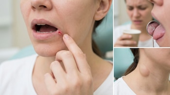 Primer plano de una mujer mostrando una úlcera en el labio, una lesión blanquecina en la lengua con espejo y un bulto palpable en el cuello.