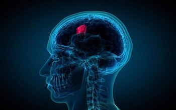Glioblastoma. (Penn Medicine)