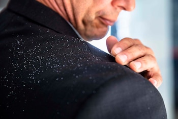 La caspa puede ser una