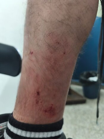 Las marcas en la pierna