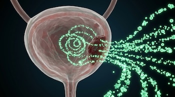 Visualización 3D de una vejiga semitransparente con un tumor interno y partículas verdes biotecnológicas que se dirigen hacia la lesión.