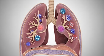Ilustración 3D realista de un pulmón humano en sección, con un tumor visible y grupos de células inmunes de colores variados, algunas marcadas con P2RX7.