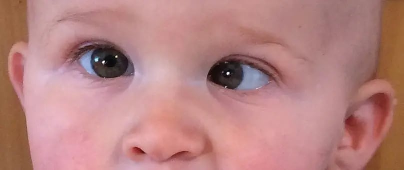 El diagnóstico tradicional del estrabismo requiere múltiples pruebas y equipos especializados (Archivo Katherine A. Lee/ Academia Estadounidense de Oftalmología)