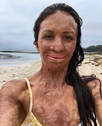 Turia Pitt sufrió quemaduras de