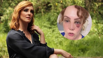 ¿Qué le pasó a Fran Meric? La actriz reaparece con un ojo morado y heridas en la nariz