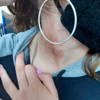 Así le quedó el cuello