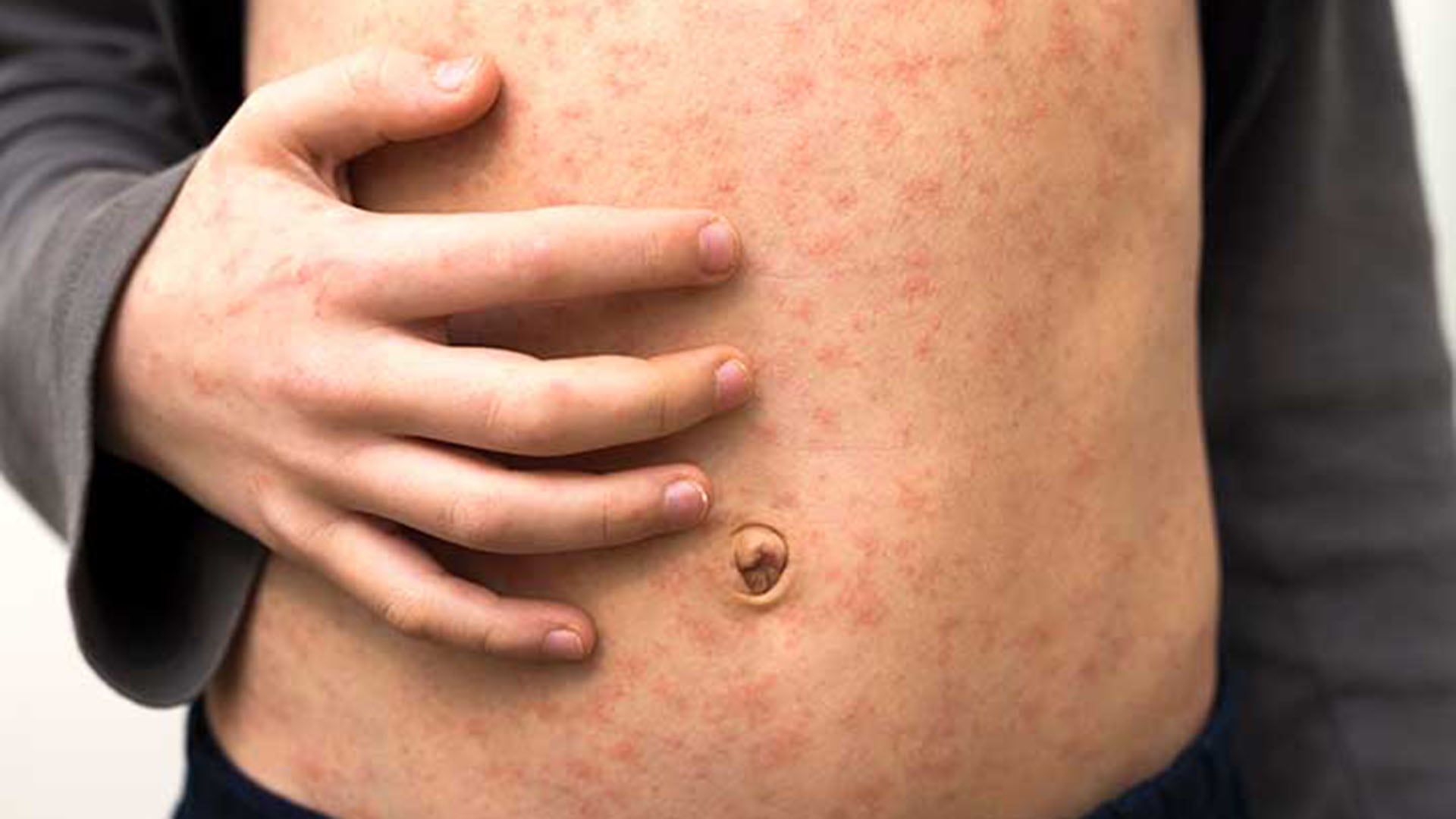 El GHP-88310 emerge como el primer candidato antiviral oral eficaz contra ortopramixovirus, incluyendo sarampión y parainfluenza humana./Archivo Infobae