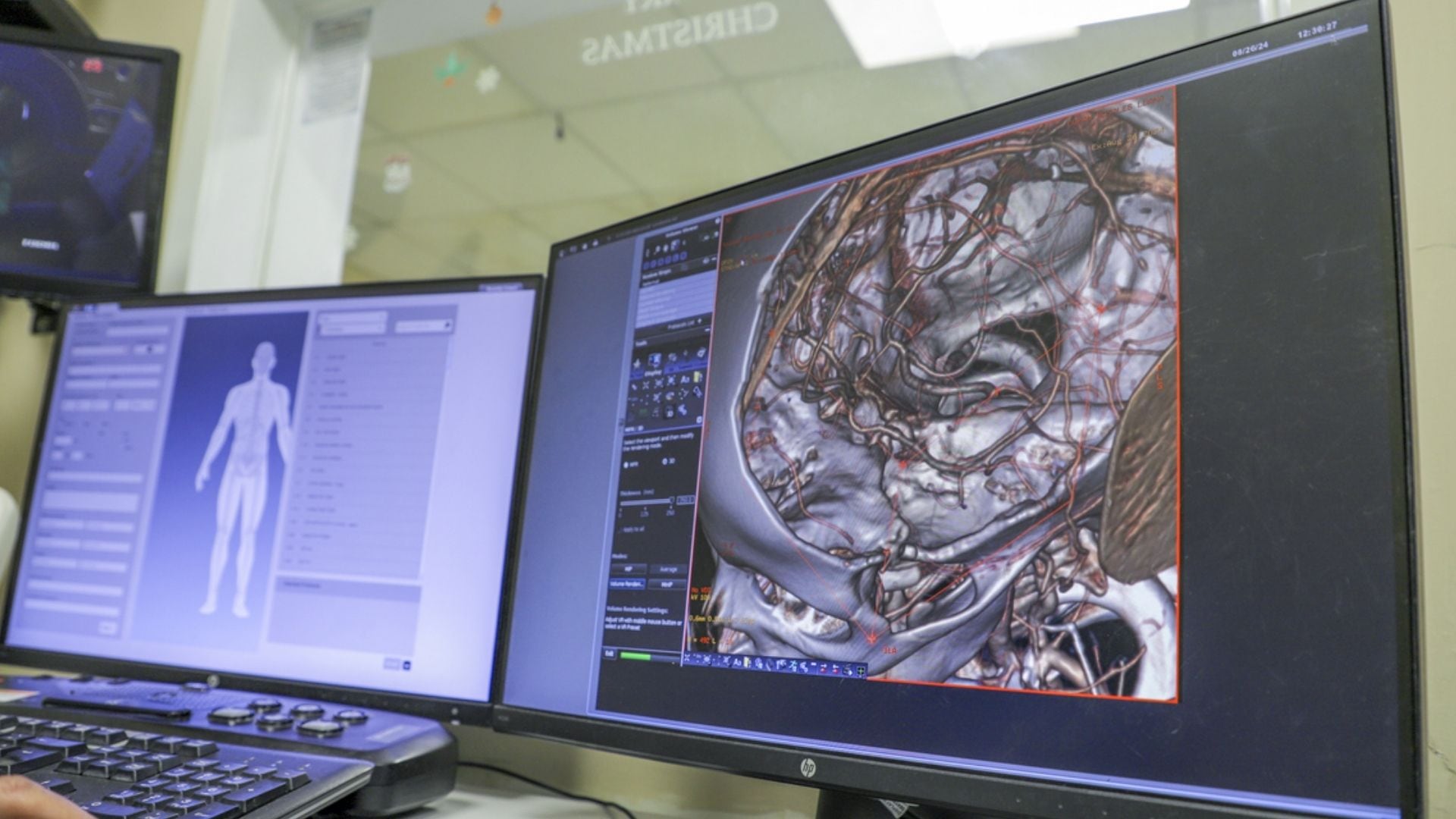 NUEVO ANTICOAGULANTE REDUCE ICTUS SIN AUMENTAR HEMORRAGIAS