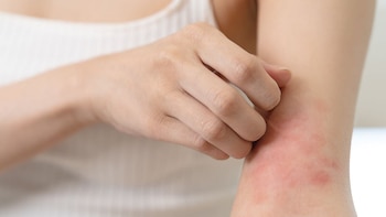 La mayoría de los pacientes