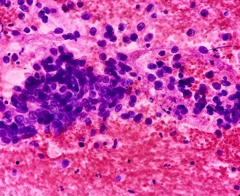 El avance científico permite comprender por qué los tumores cutáneos presentan menor mortalidad y suelen ser menos agresivos frente a otros tejidos (Universidades de Manchester )