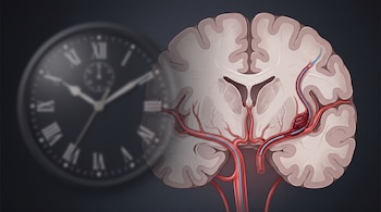 Ilustración de un corte de cerebro con arterias, un catéter que alcanza un coágulo y un reloj analógico desenfocado en segundo plano.