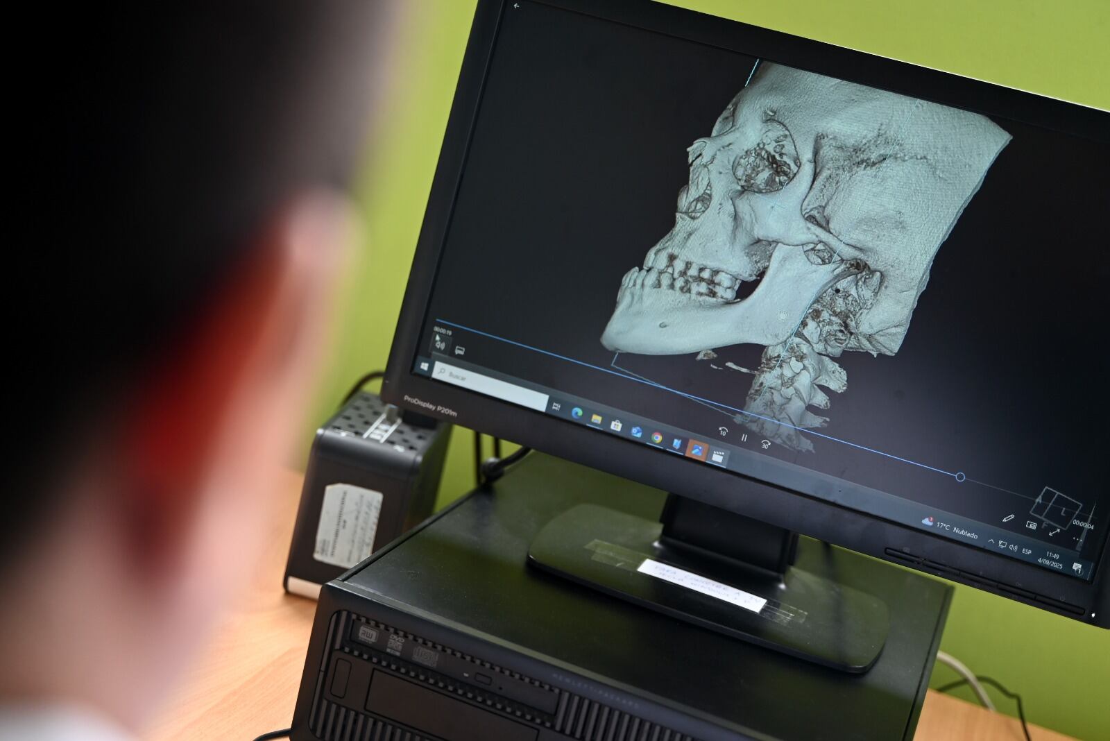 La adolescente tenía una malformación. ( Foto: INSN)