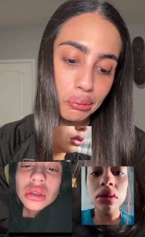 La mujer denuncia inyección de silicona con aceite industrial en sus labios (Hillary.escriba)