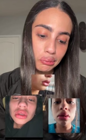 La mujer denuncia inyección de silicona con aceite industrial en sus labios