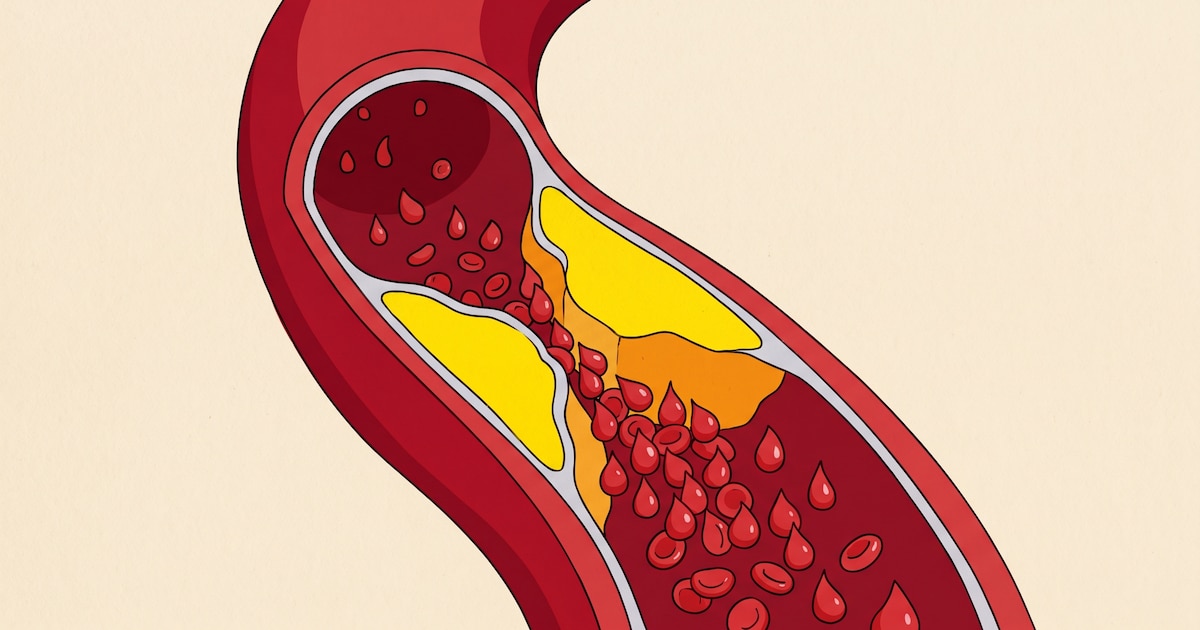 Photo: infobae.com Good vs. Bad Cholesterol: Differences, Risks, and New Medical Guidelines