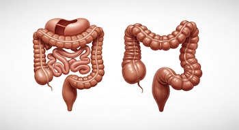 Ilustración médica de dos intestinos gruesos. El de la izquierda es un colon sano de tamaño normal. El de la derecha es un colon extremadamente dilatado y distendido.