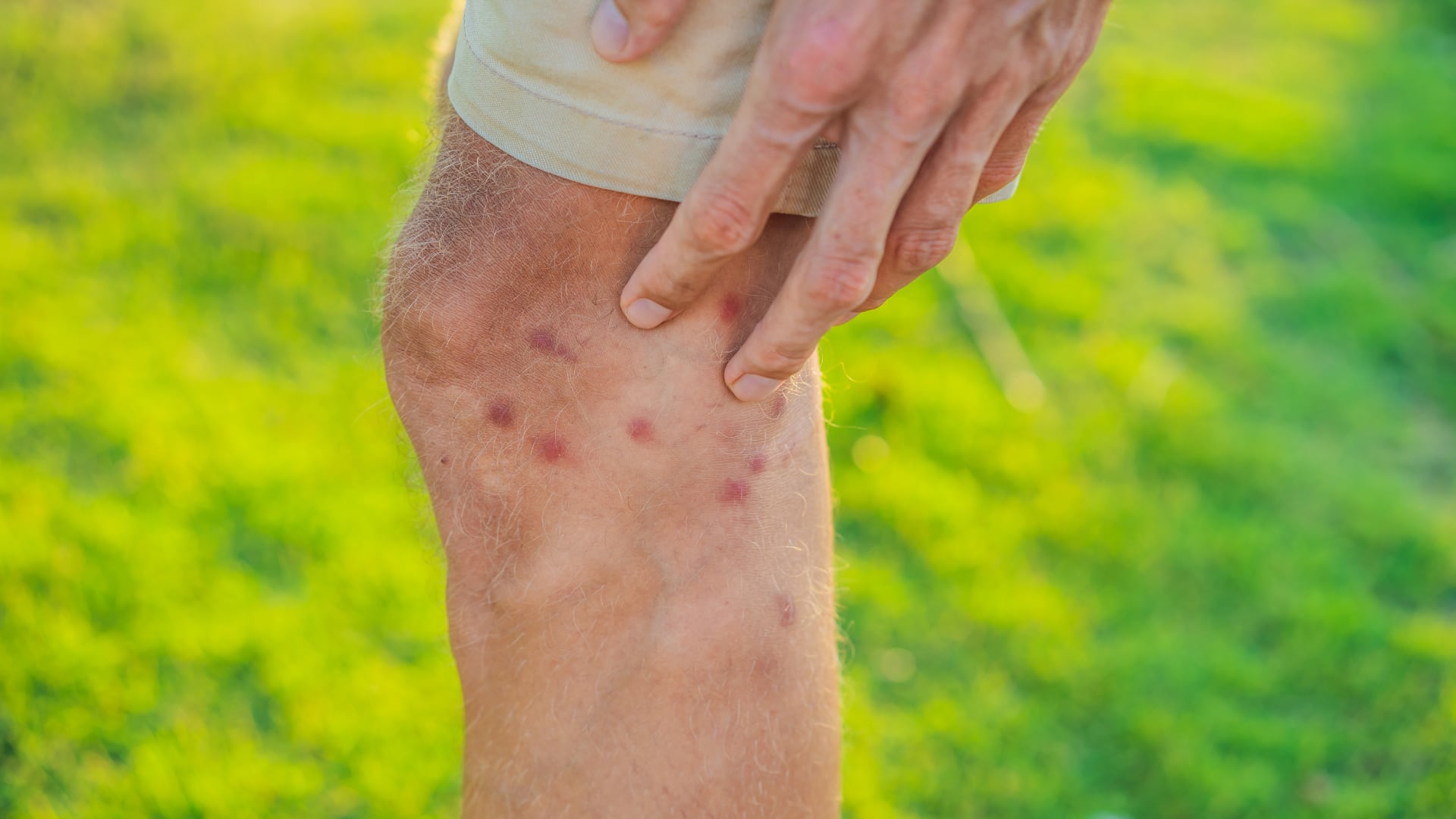 El virus Oropouche puede presentar diversos síntomas, entre ellos, la aparición de sarpullidos - crédito Canva