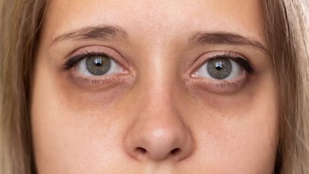 Rosalba Herrero, doctora: “Las ojeras